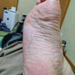 24時間歩いたあとの足の裏